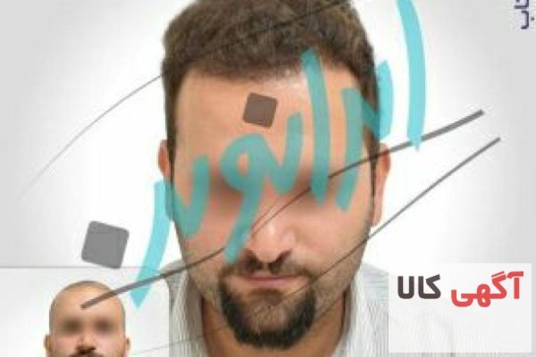 کاشت مو طبیعی با یک میلیون تومان